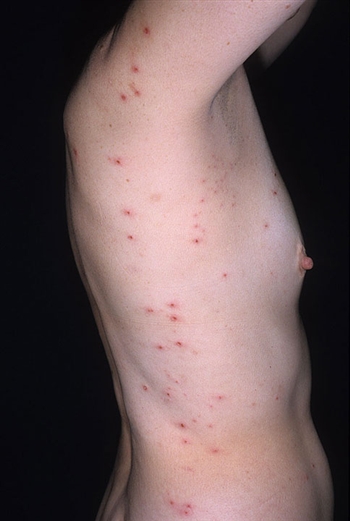 Dermatitis herpetiformis Hals